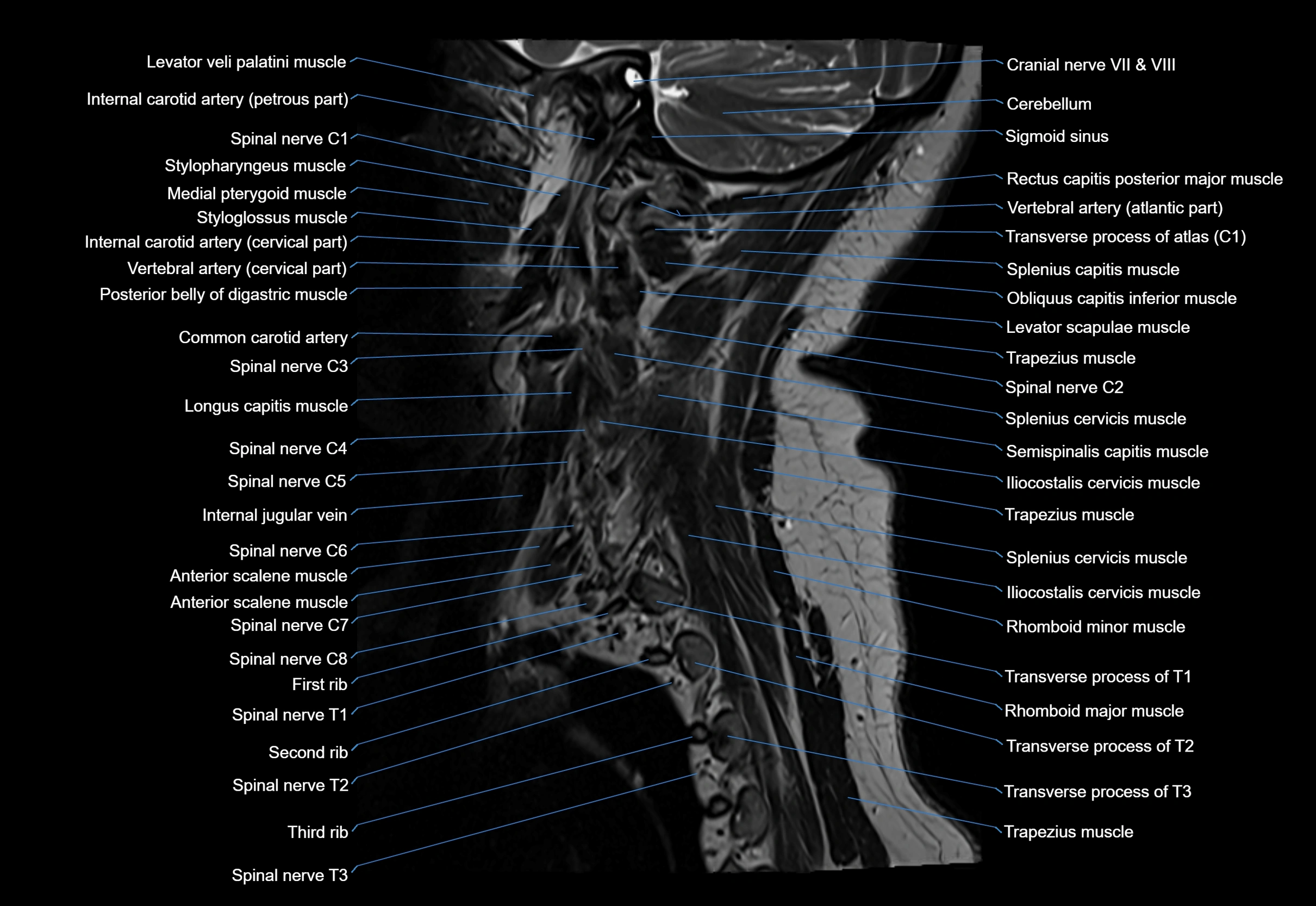 cervical spine cross sectional MRI anatomy 3T MRI  sagittal image-img-00001-00029.webp